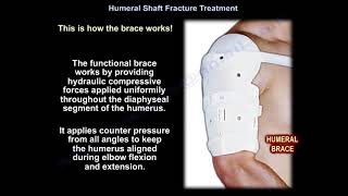 Humeral Shaft Fracture Treatment  Everything You Need To Know  Dr Nabil Ebraheim [upl. by Pinkerton]