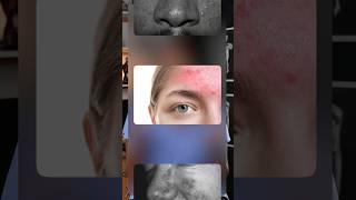 Acne Rosacea Explained acne rosacea [upl. by Attlee293]