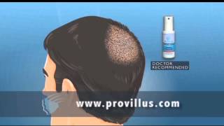 Provillus Spray for Men Hair Loss Treatment Reviews [upl. by Enar]