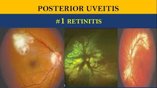 POSTERIOR UVEITIS  retinitis vs choroiditis [upl. by Lear]