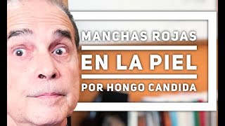 Episodio 1259 Manchas Rojas En La Piel Por Hongo Cándida [upl. by Sandy]