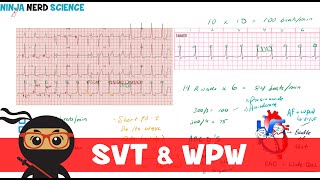 Rate and Rhythm  Supraventricular Tachycardia SVT and WolffParkinsonWhite WPW Syndrome [upl. by Miriam468]