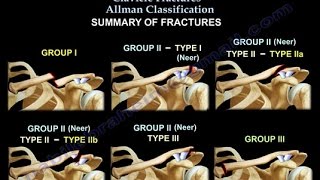 Clavicle Fractures Classification  Everything You Need To Know  Dr Nabil Ebraheim [upl. by Helbonnas]