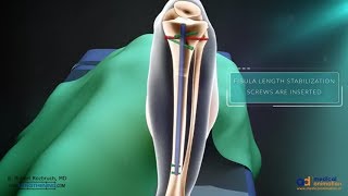 Precice Tibia Lengthening Surgical Animation [upl. by Nelag]