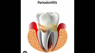 What is periodontitisWhat is periodontitis diseasePeriodontitissorts smile [upl. by Arramahs]