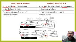 DIFFERENCE BETWEEN DECEREBRATE AND DECORTICATE RIGIDITY DECORTICATERIGIDITY DECEREBRATERIGIDITY [upl. by Yhtir]