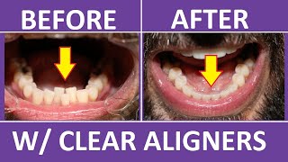 Invisalign Braces Before and After Overbite Crowding Teeth Cost Pain Tips 3M Clear Aligners [upl. by Giusto]