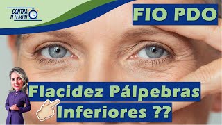 Como reduzir a FLACIDEZ nas PÁLPEBRAS Inferiores  Fio PDO na região do terço superior da face [upl. by Dolli511]