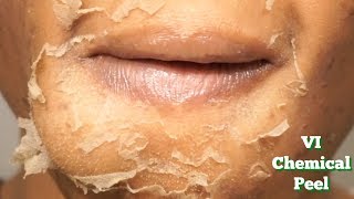 CHEMICAL PEEL Full Process  Procedure  Peeling  Before amp After [upl. by Atteinotna]