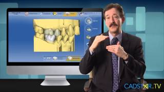 Parameters Impacting Occlusion for CEREC Bluecam and Omnicam [upl. by Winfrid544]