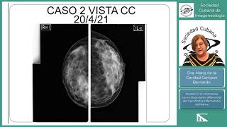 Mastitis granulomatosa diagnóstico diferencial del cáncer de mama Dra Maria Caridad Campos [upl. by Skilken230]