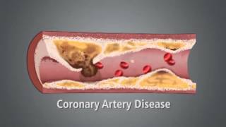 What causes a heart attack [upl. by Bordiuk]