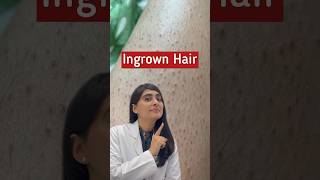 Ingrown Hair Removal  Ingrown Hair  Strawberry Legs shorts [upl. by Alisa]