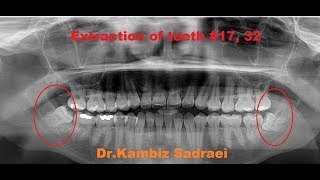 Extraction of Wisdom Teeth 17 amp 32 by DrKambiz Sadraei [upl. by Nitsur]