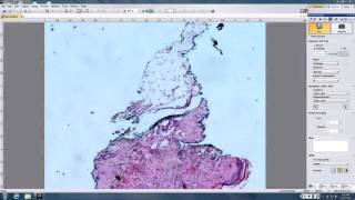 Dirk Elston Dermatopathology slides Nov 17 2015 [upl. by Peta]