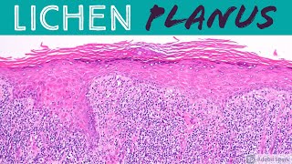 Lichen Planus amp Hypertrophic Lichen Planus Inflammatory Dermpath 101 for Dermatology amp Pathology [upl. by Armalla]