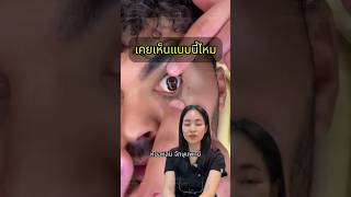 โรคตา หมอหลิน จักษุแพทย์ หมอตา สารพัดเรื่องตา ศัลยกรรมตา รู้จากtiktok tiktokuni polycoria [upl. by Nirraj]