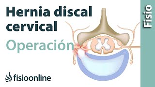 Hernia discal cervical Operación quirúrgica o cirugía [upl. by Ylek935]