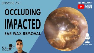 751  Occluding Impacted Ear Wax Removal [upl. by Nuriel]