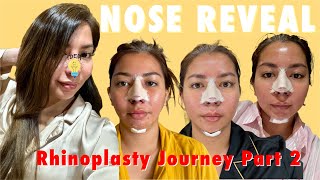 Rhinoplasty Journey Part 2  After Bandage The Final Look   Anna Magkawas [upl. by Ajar]