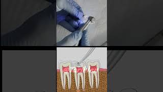 Kanal Tedavisi Nasıl Yapılır  diş dolgusu dental dentist diş shorts kanaltedavisi rootcanal [upl. by Nykal640]