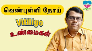 வெண் புள்ளி நோய்  Vitiligo  உண்மைகள்  தமிழ் [upl. by Konstance]