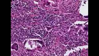 Histopathology Temporal artery Temporal arteritis [upl. by Ydnik]