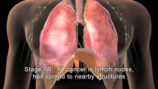 English MAKNA Getting to know Lung Cancer [upl. by Salsbury]