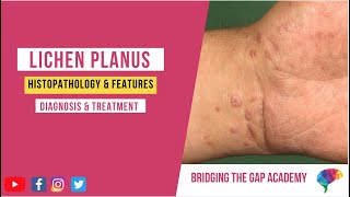 What is Lichen Planus Histopathology amp Features Diagnosis amp Treatment [upl. by Cattan774]