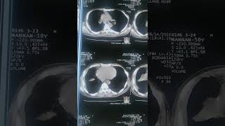 Decreased lung volume without any parenchymal abnormality [upl. by Laurie]