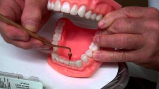 Rubber Tip Stimulator  Oral Hygiene Instructions by Dr Berdy periodontist Jacksonville FL [upl. by Oirevas923]