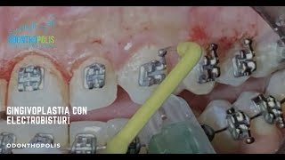 Gingivoplastia Con ElectroBisturí [upl. by Summers]