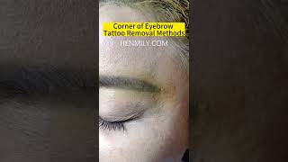 Eyebrow Tattoo Removal Before And AfterPicosecond Laser Tattoo China Laser Beauty Machine Supplier [upl. by Thill15]