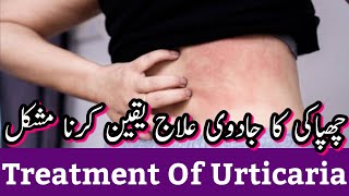 Urticaria Treatment Home Remedy In Urdu  Urticaria Ka Ilaj In Urdu [upl. by Newfeld]