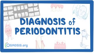 Diagnosis of Periodontitis [upl. by Joliet65]