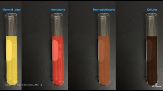 Hematuria Hemoglobinuria Hemosiderinuria and Coluria [upl. by Brien]