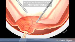 Diabetic Tractional Retinal Detachment [upl. by Nahtiek]