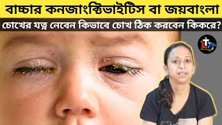 How to Cure Conjunctivitis in Kids in Bengali  bacha der joy bangla [upl. by Ahcrop402]