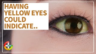 Health Talk Causes and Conditions of Yellow Eyes [upl. by Eilarol]