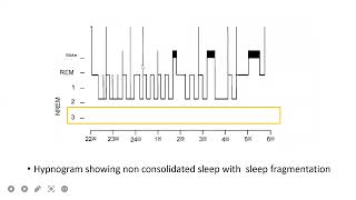 polysomnography report interpretation [upl. by Yeldahc]