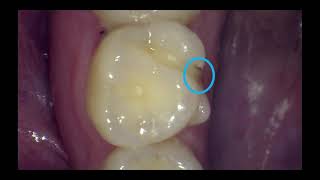 What does a cavity look like [upl. by Albertson]