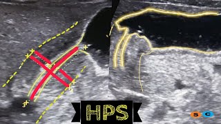 Hypertrophic pyloric stenosis [upl. by Ki]