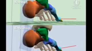 Comparison of Normal Gait to Equinus Gait [upl. by Chappie]