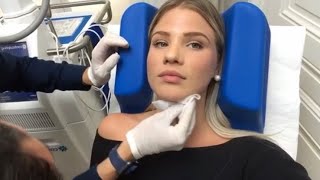 CoolSculpting double menton cryolipolisecryothérapie [upl. by Annelise]