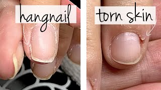 Hangnail or Torn Skin Do You Know the Difference [upl. by Iaras]