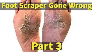 Cracked Heels So satisfying 9 mins Dead skin removal and Cracked heel treatment [upl. by Thurstan761]