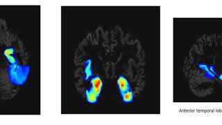 Modeling Spatial Progression of Dementia caused by Alzheimers disease with Deep Learning [upl. by Leamaj]