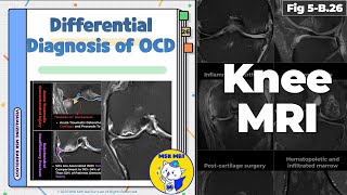 Fig 5B26 Differential Diagnosis of Osteochondritis Dissecans [upl. by Nomae]