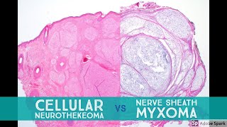 Cellular Neurothekeoma vs Nerve Sheath Myxoma  Dermpath Lookalikes [upl. by Larue]