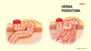 Cuidados de enfermagem com estomas intestinais parte 3 [upl. by Binni234]